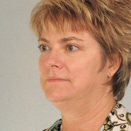 Facelift Before & After Gallery - Patient 256884 - Image 3