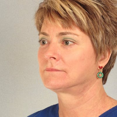 Facelift Before & After Gallery - Patient 256884 - Image 4