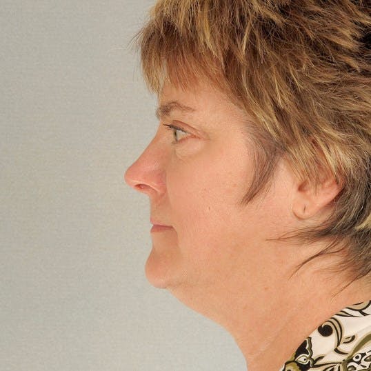 Facelift Before & After Gallery - Patient 256884 - Image 5