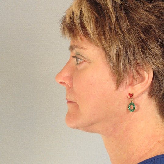 Facelift Before & After Gallery - Patient 256884 - Image 6