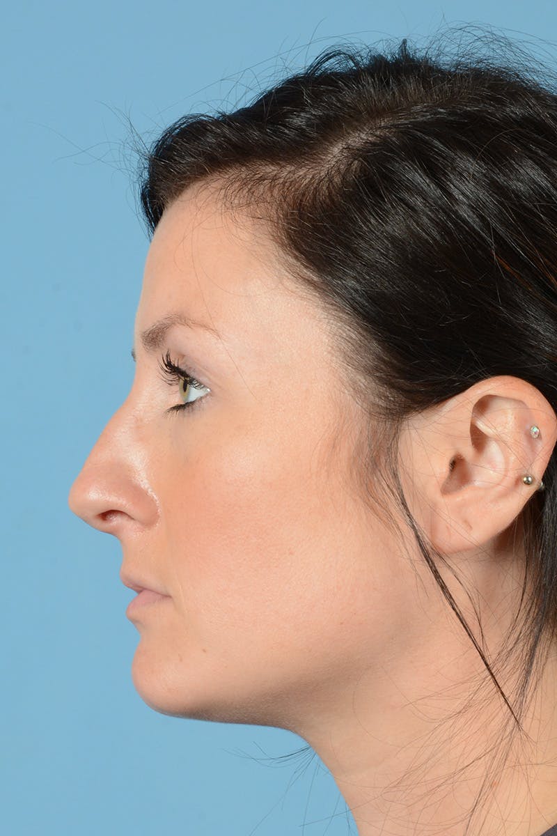 Rhinoplasty Before & After Gallery - Patient 284204 - Image 7