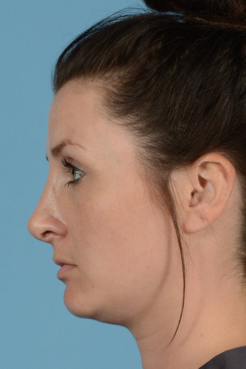 Rhinoplasty Before & After Gallery - Patient 284204 - Image 8