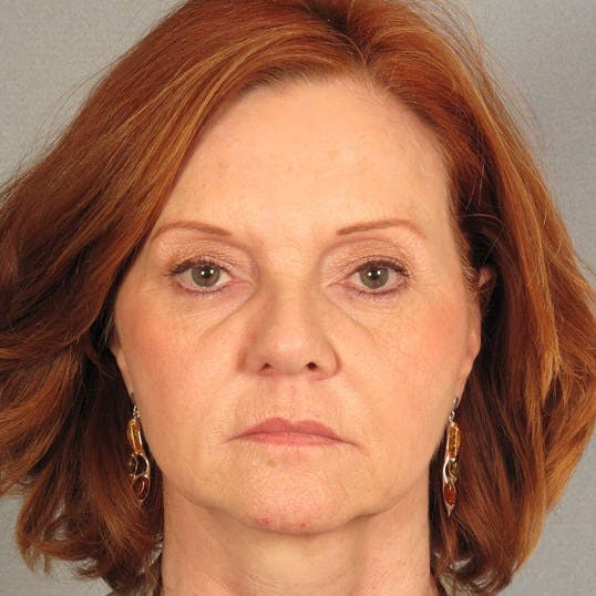 Facelift Before & After Gallery - Patient 287025 - Image 1