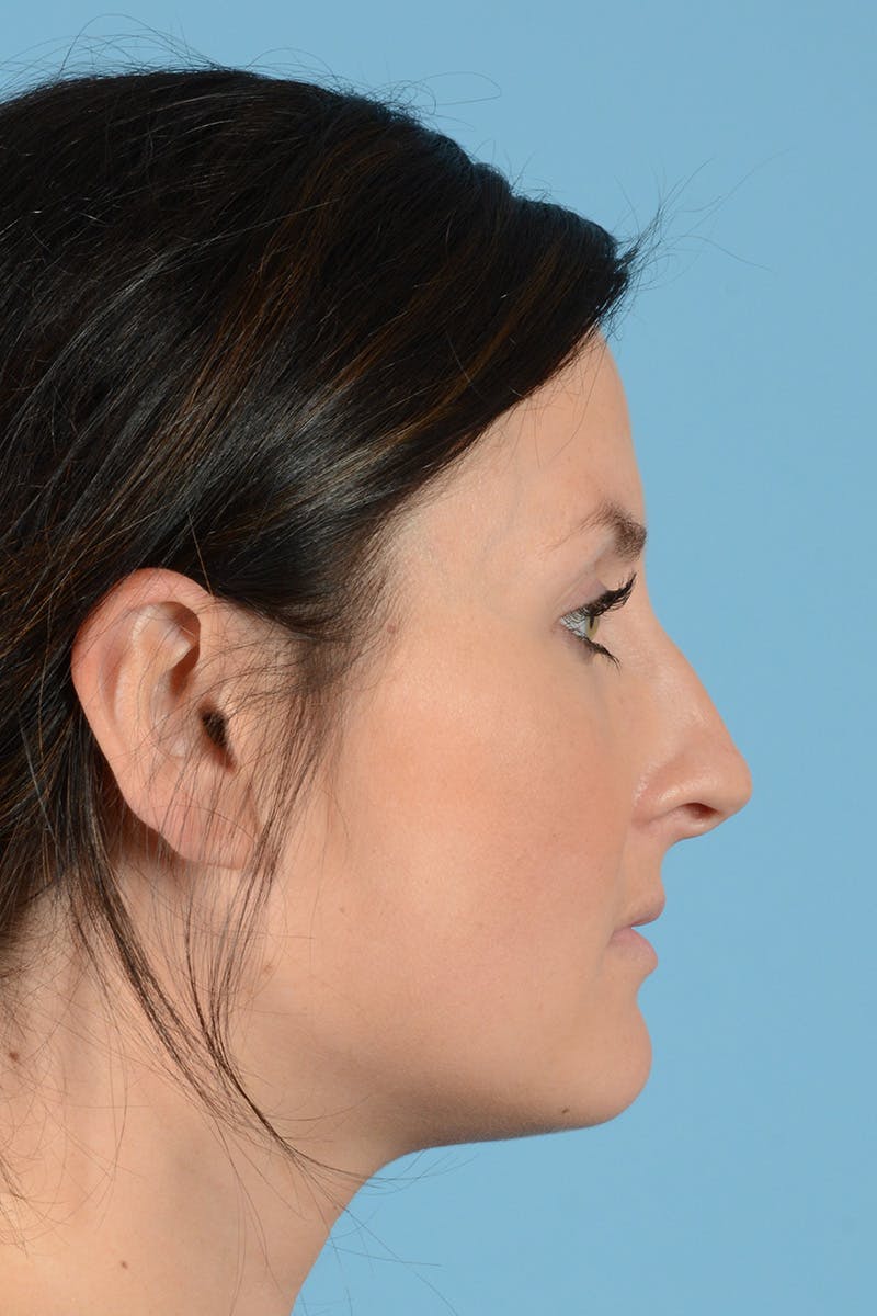 Rhinoplasty Before & After Gallery - Patient 284204 - Image 9