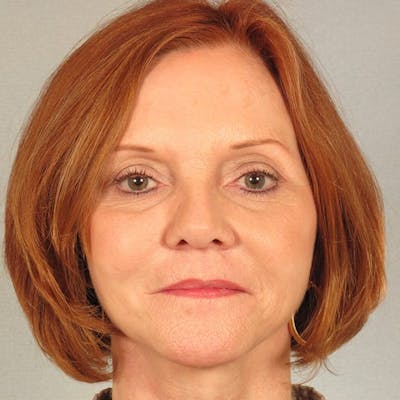 Facelift Before & After Gallery - Patient 287025 - Image 2