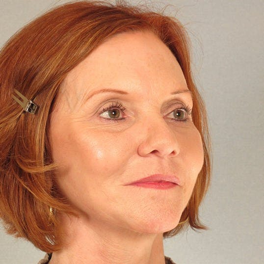 Facelift Before & After Gallery - Patient 287025 - Image 4