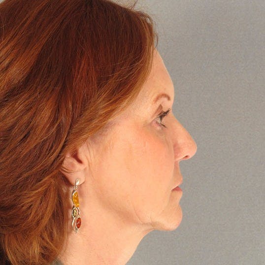 Facelift Before & After Gallery - Patient 287025 - Image 5