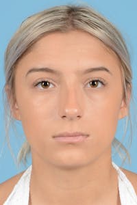 Rhinoplasty Before & After Gallery - Patient 239056 - Image 1