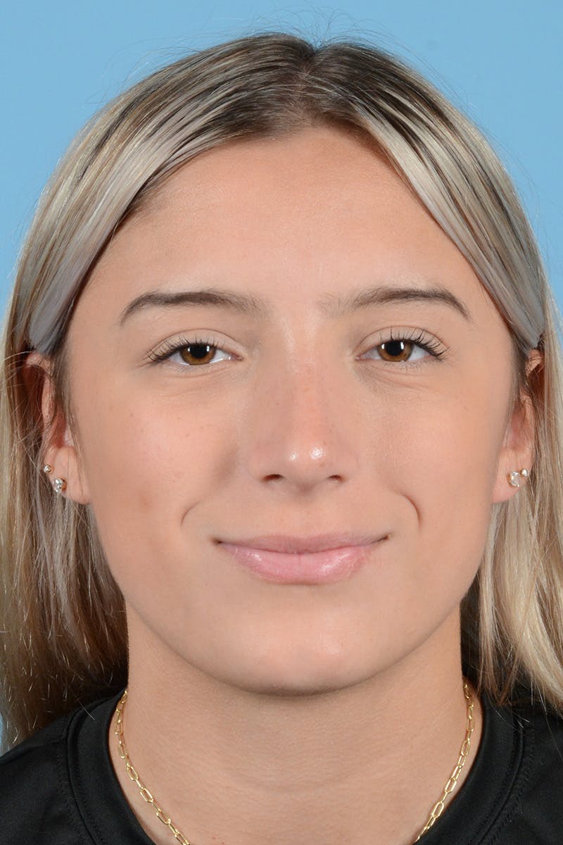 Rhinoplasty Before & After Gallery - Patient 239056 - Image 2