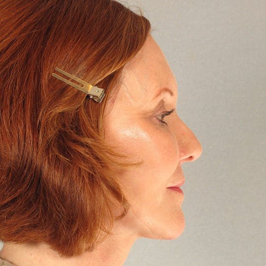 Facelift Before & After Gallery - Patient 287025 - Image 6