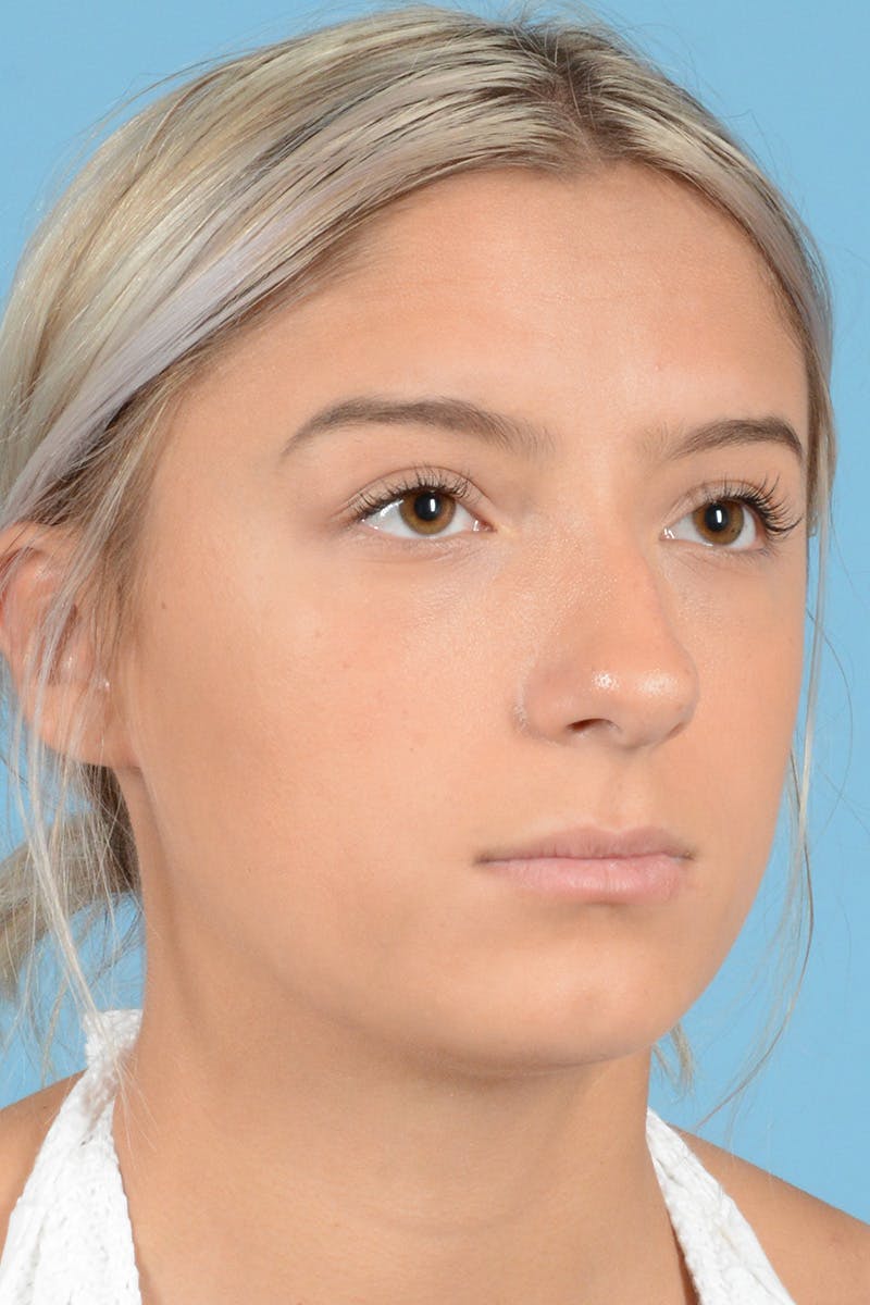 Rhinoplasty Before & After Gallery - Patient 239056 - Image 3