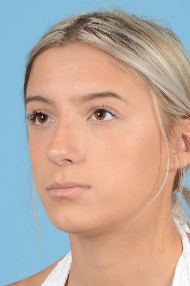 Rhinoplasty Before & After Gallery - Patient 239056 - Image 7