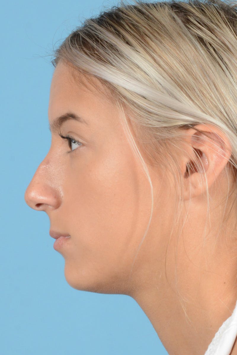 Rhinoplasty Before & After Gallery - Patient 239056 - Image 9