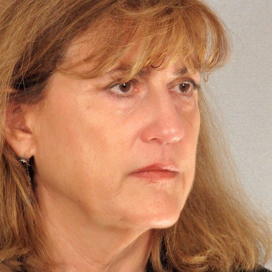 Facelift Before & After Gallery - Patient 268944 - Image 3