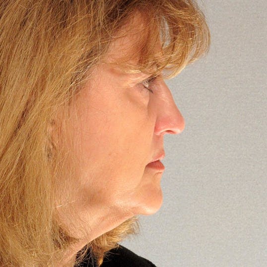 Facelift Before & After Gallery - Patient 268944 - Image 5