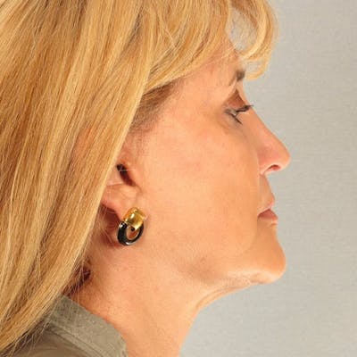 Facelift Before & After Gallery - Patient 268944 - Image 6