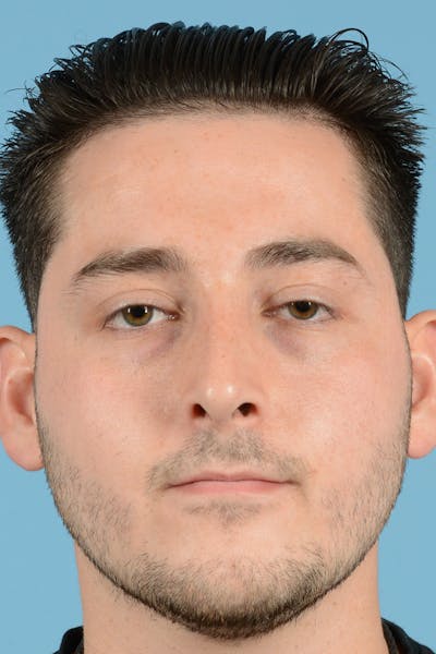 Rhinoplasty Before & After Gallery - Patient 318373 - Image 2