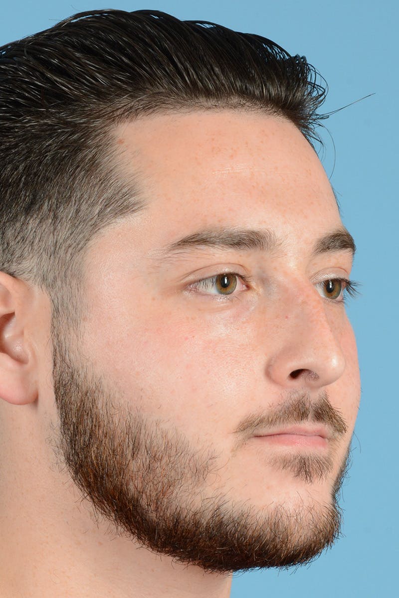 Rhinoplasty Before & After Gallery - Patient 318373 - Image 3