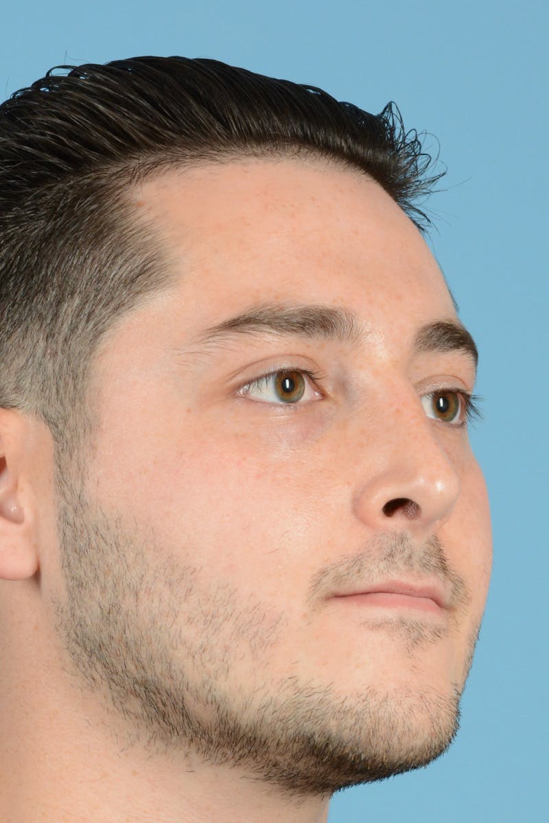Rhinoplasty Before & After Gallery - Patient 318373 - Image 4