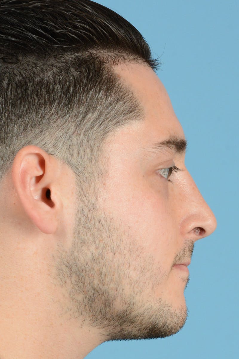 Rhinoplasty Before & After Gallery - Patient 318373 - Image 6