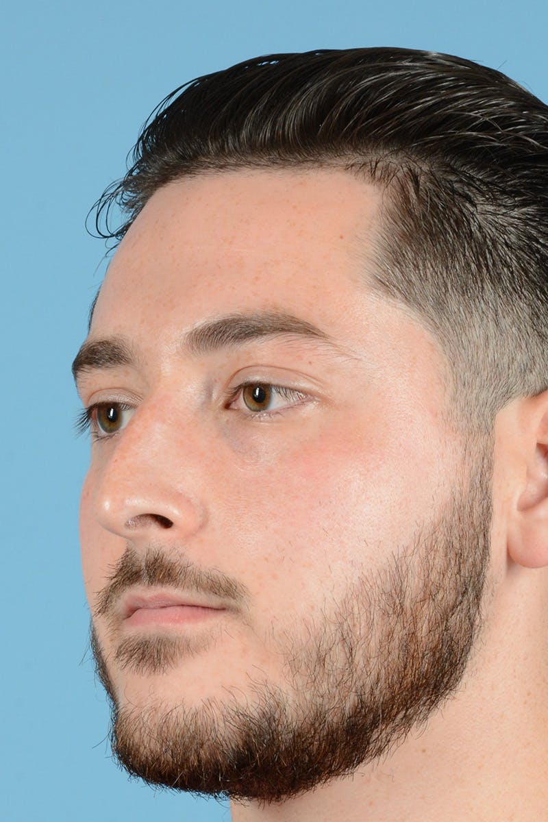 Rhinoplasty Before & After Gallery - Patient 318373 - Image 7