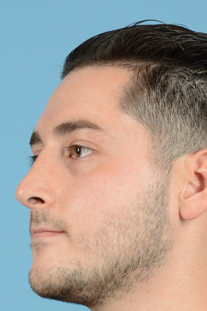 Rhinoplasty Before & After Gallery - Patient 318373 - Image 8