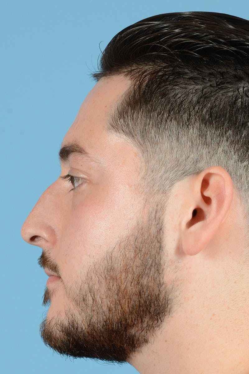 Rhinoplasty Before & After Gallery - Patient 318373 - Image 9