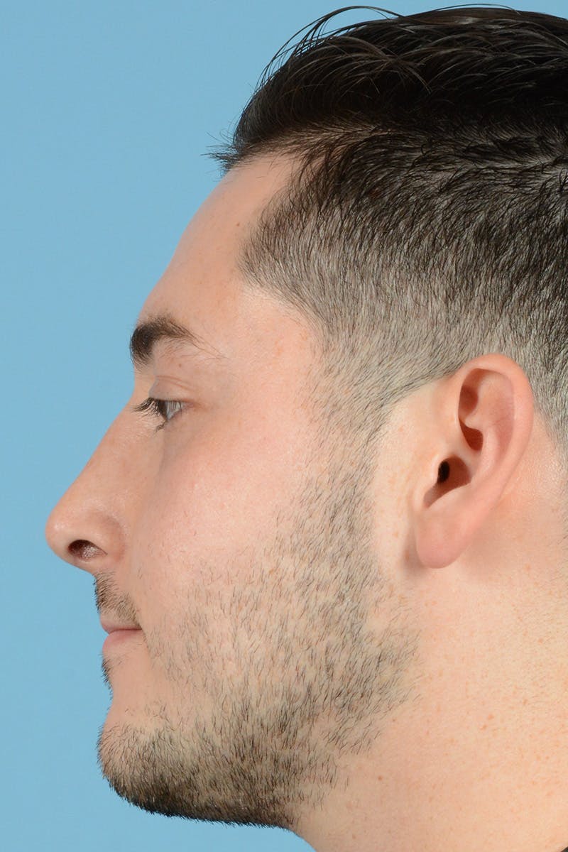 Rhinoplasty Before & After Gallery - Patient 318373 - Image 10