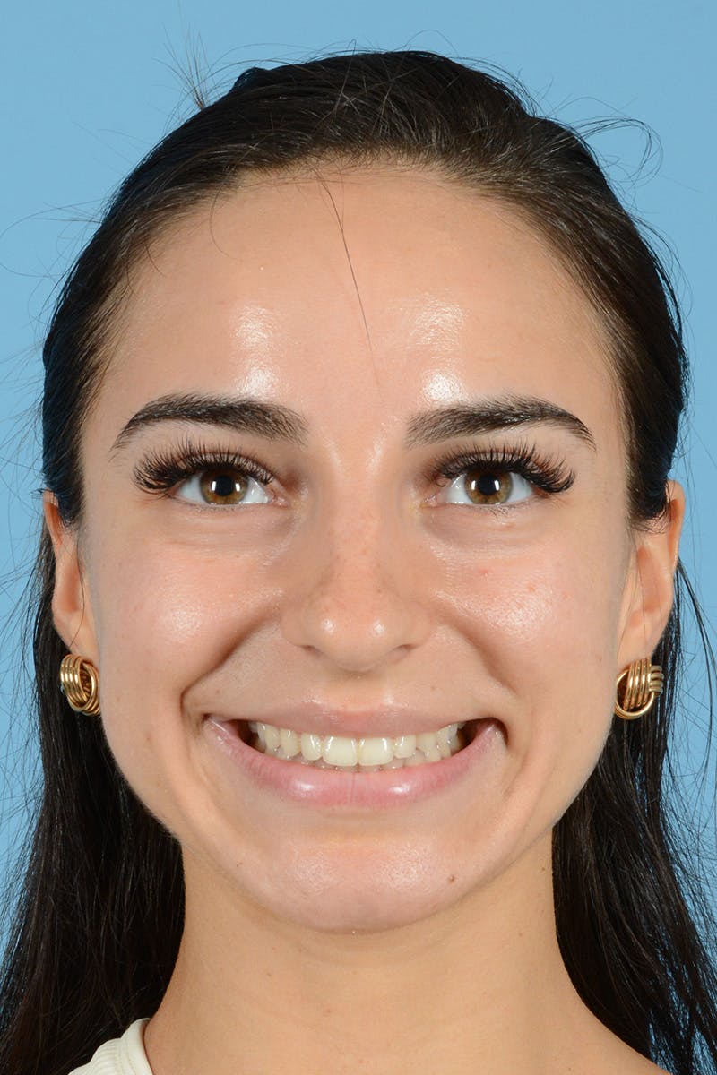Rhinoplasty Before & After Gallery - Patient 343194 - Image 3