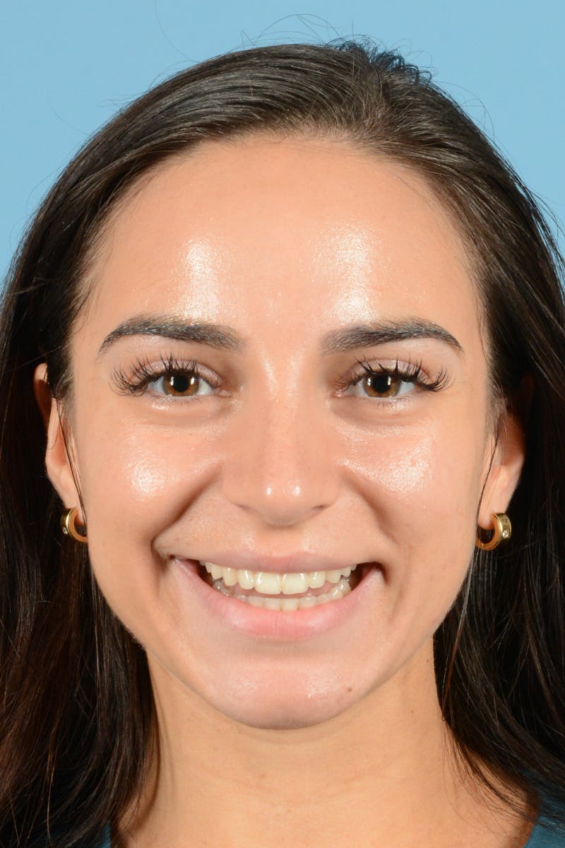 Rhinoplasty Before & After Gallery - Patient 343194 - Image 4