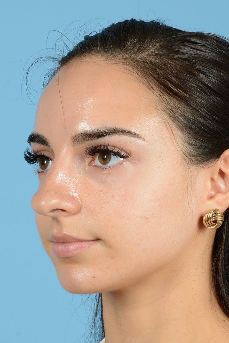 Rhinoplasty Before & After Gallery - Patient 343194 - Image 9