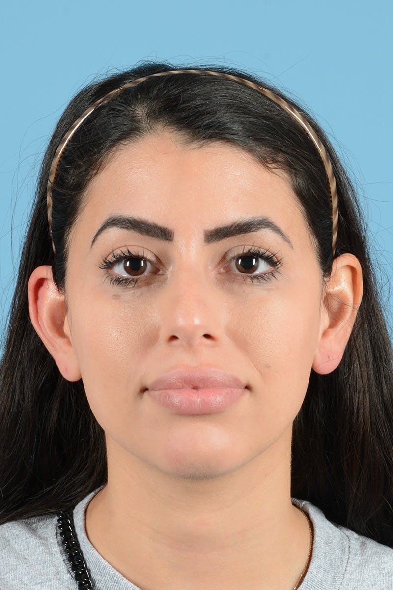 Rhinoplasty Before & After Gallery - Patient 416307 - Image 1