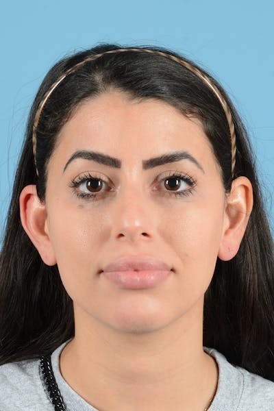 Rhinoplasty Before & After Gallery - Patient 416307 - Image 1