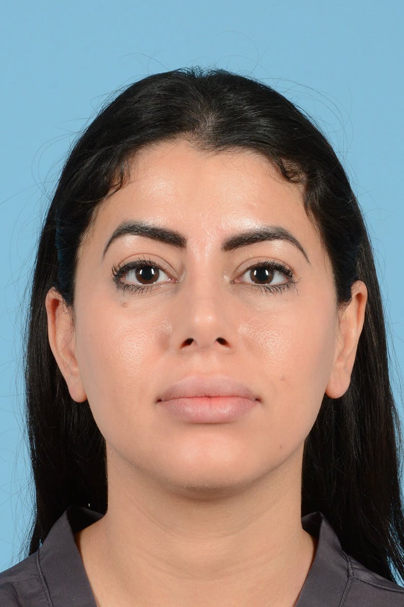 Rhinoplasty Before & After Gallery - Patient 416307 - Image 2