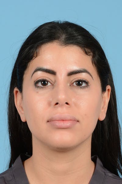 Rhinoplasty Before & After Gallery - Patient 416307 - Image 2