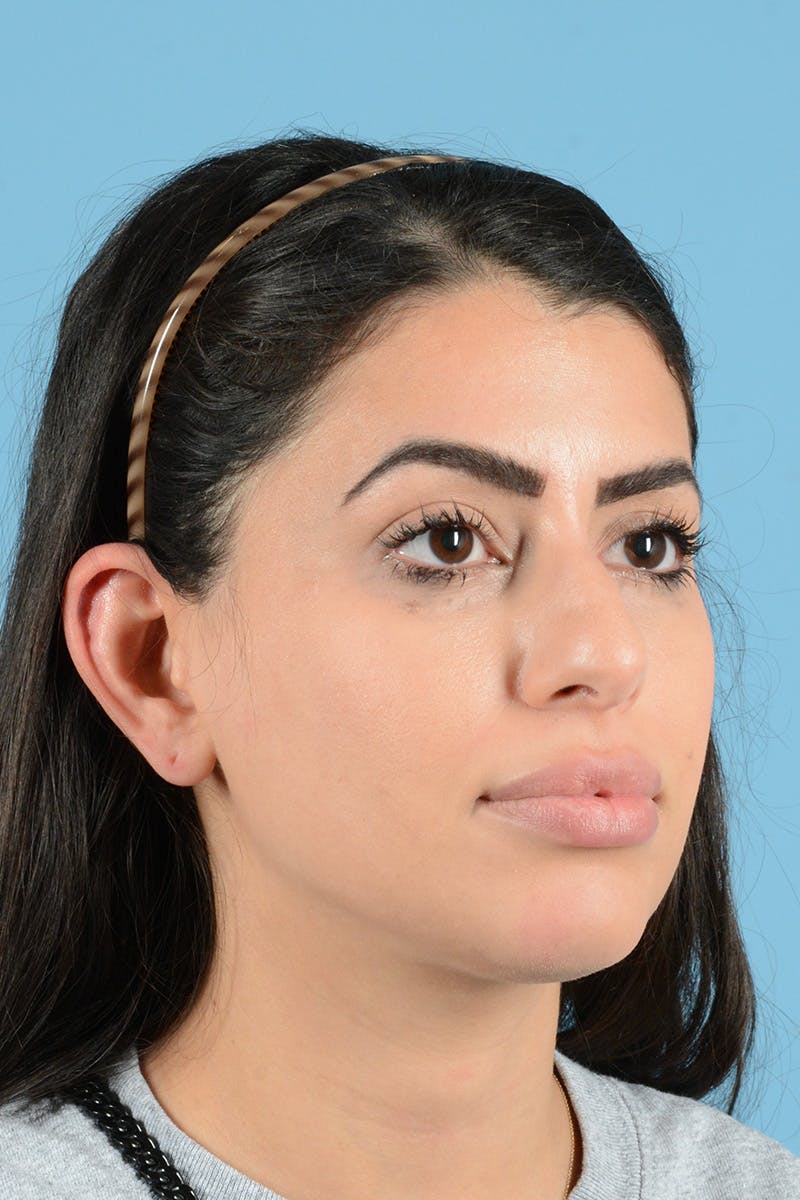 Rhinoplasty Before & After Gallery - Patient 416307 - Image 3