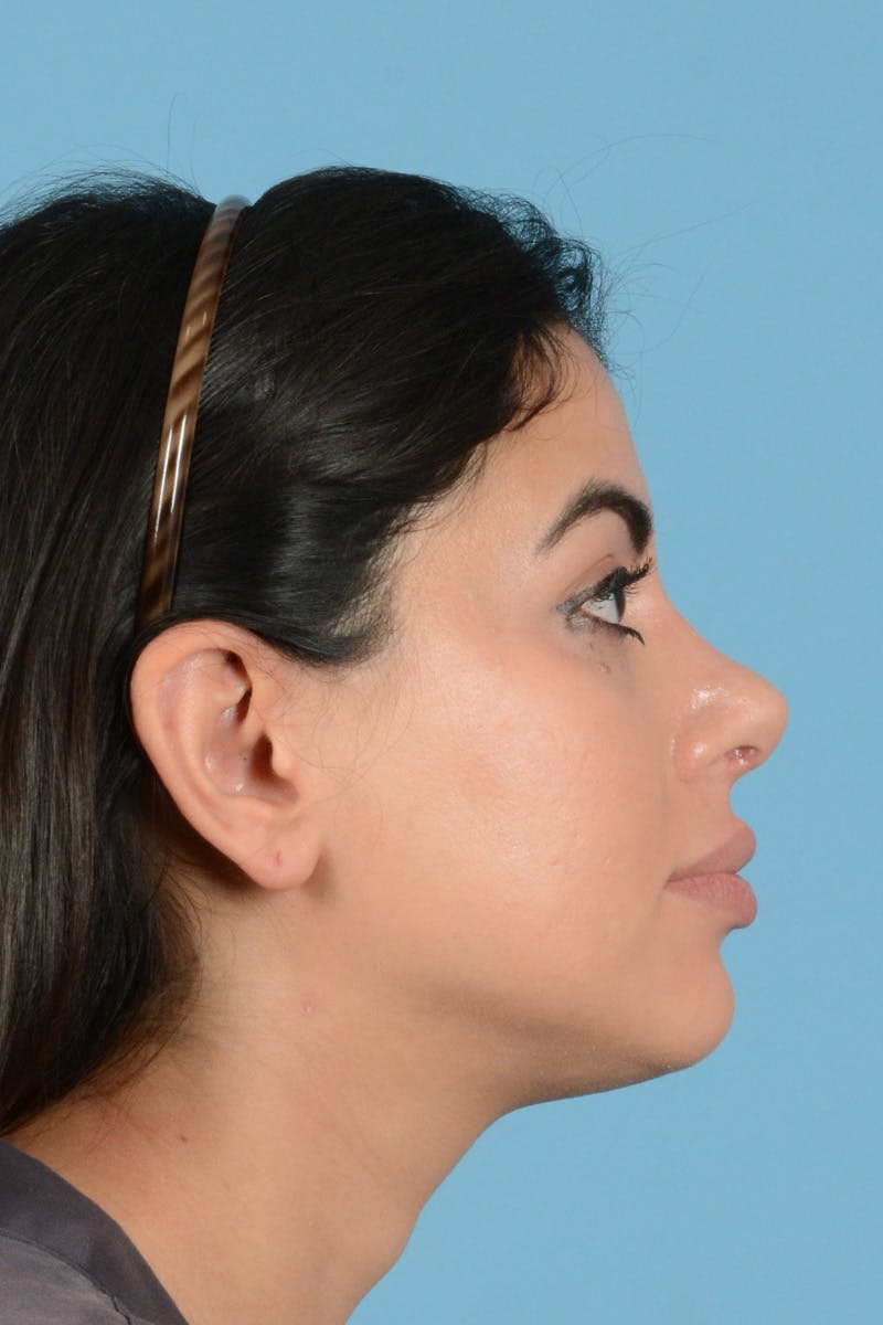 Rhinoplasty Before & After Gallery - Patient 416307 - Image 6