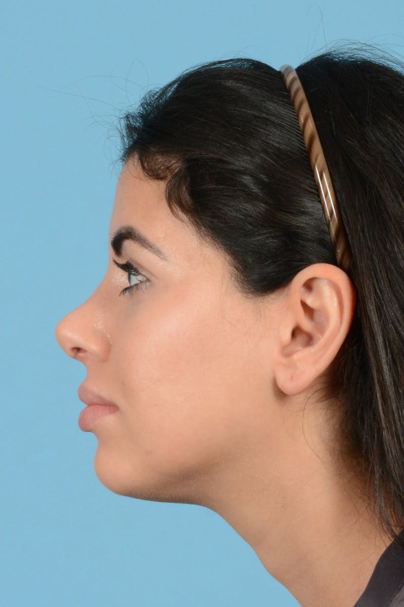 Rhinoplasty Before & After Gallery - Patient 416307 - Image 10