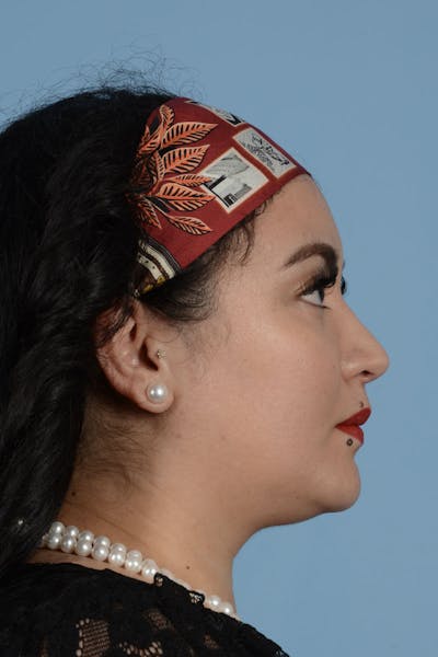 Rhinoplasty Before & After Gallery - Patient 181546 - Image 2