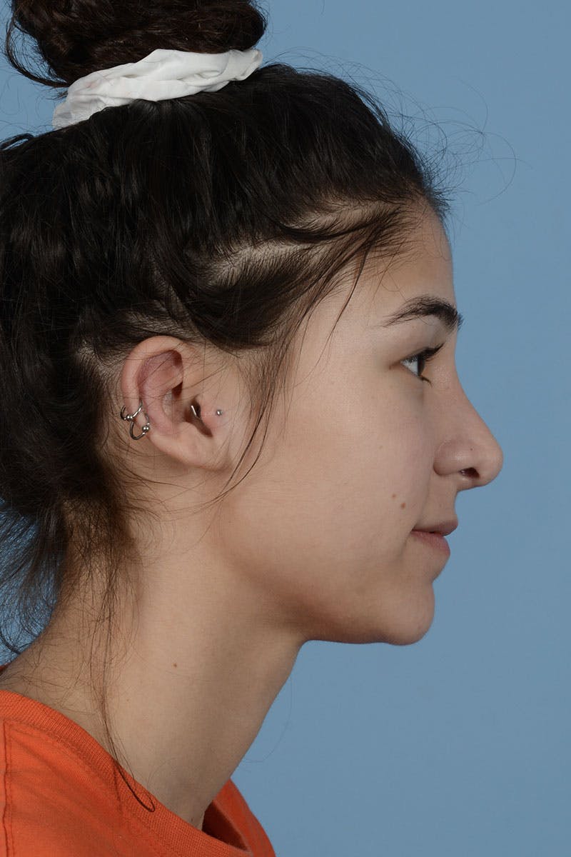 Rhinoplasty Before & After Gallery - Patient 182017 - Image 2