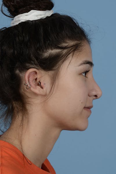 Rhinoplasty Before & After Gallery - Patient 182017 - Image 2