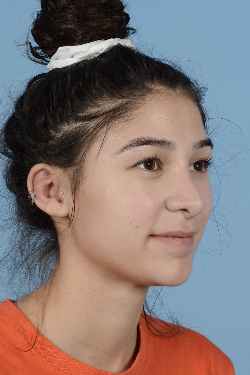 Rhinoplasty Before & After Gallery - Patient 182017 - Image 4