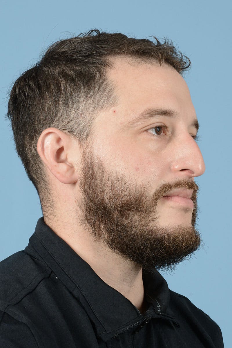 Rhinoplasty Before & After Gallery - Patient 987040 - Image 3