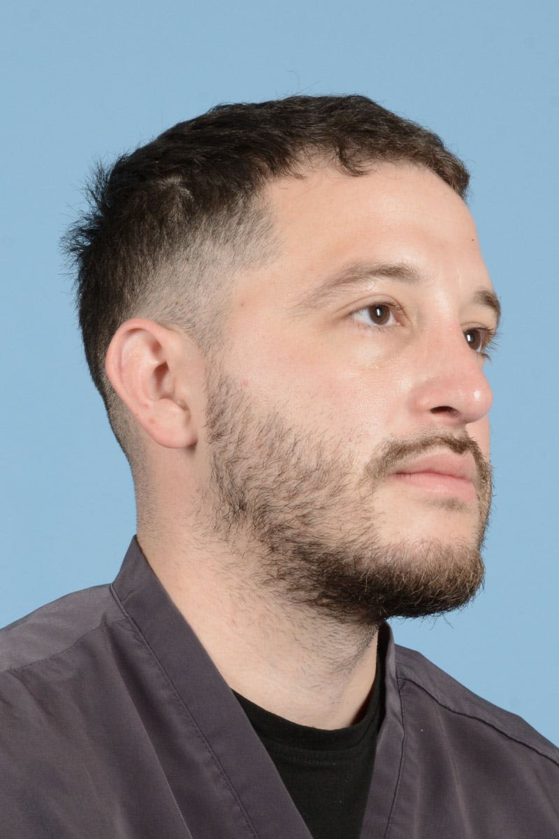 Rhinoplasty Before & After Gallery - Patient 987040 - Image 4