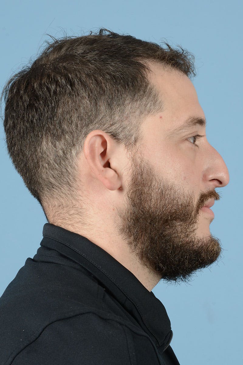 Rhinoplasty Before & After Gallery - Patient 987040 - Image 5