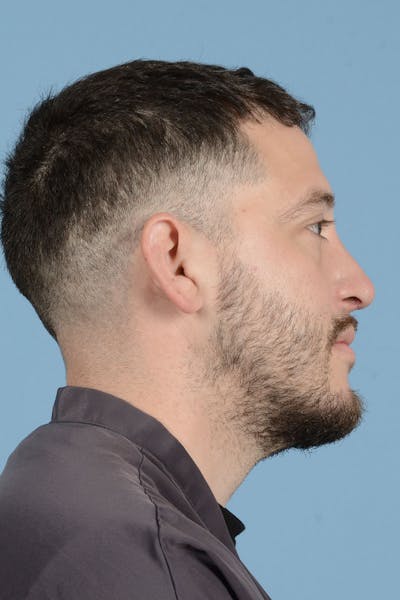 Rhinoplasty Before & After Gallery - Patient 987040 - Image 6