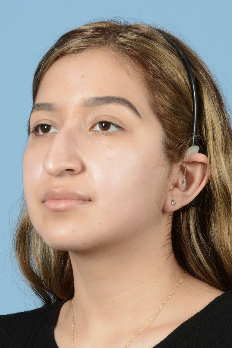 Rhinoplasty Before & After Gallery - Patient 336440 - Image 3