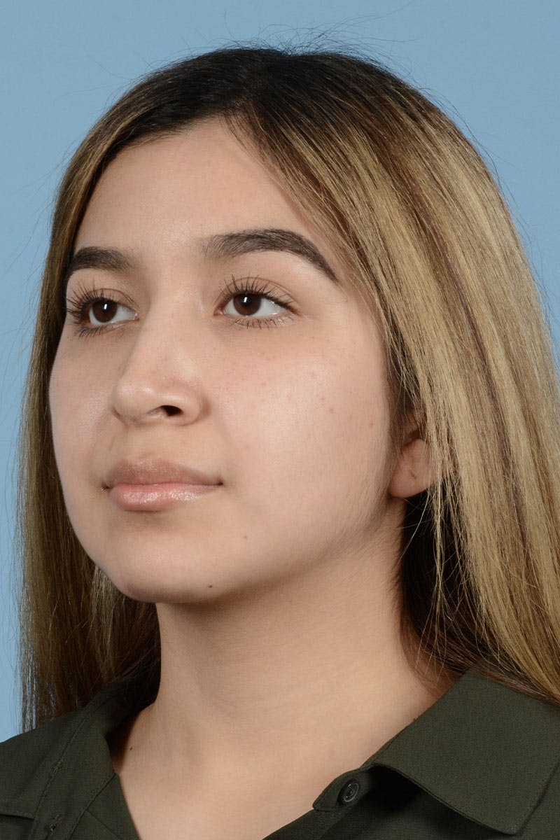 Rhinoplasty Before & After Gallery - Patient 336440 - Image 4