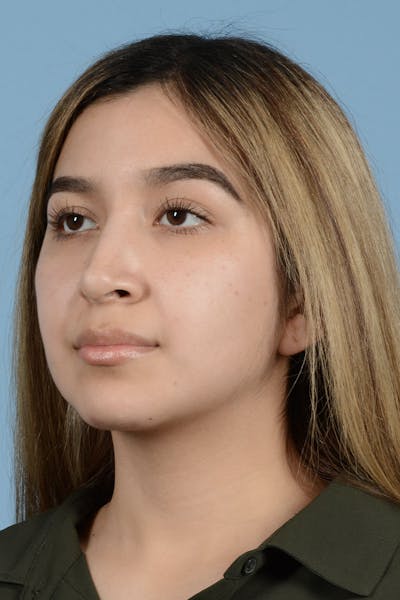 Rhinoplasty Before & After Gallery - Patient 336440 - Image 4