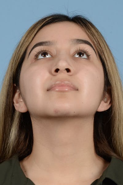 Rhinoplasty Before & After Gallery - Patient 336440 - Image 8